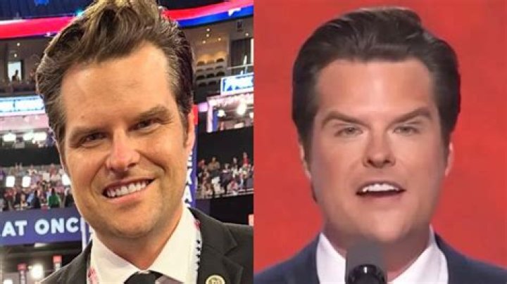 Matt Gaetz Botox Before and After: A Comprehensive Analysis