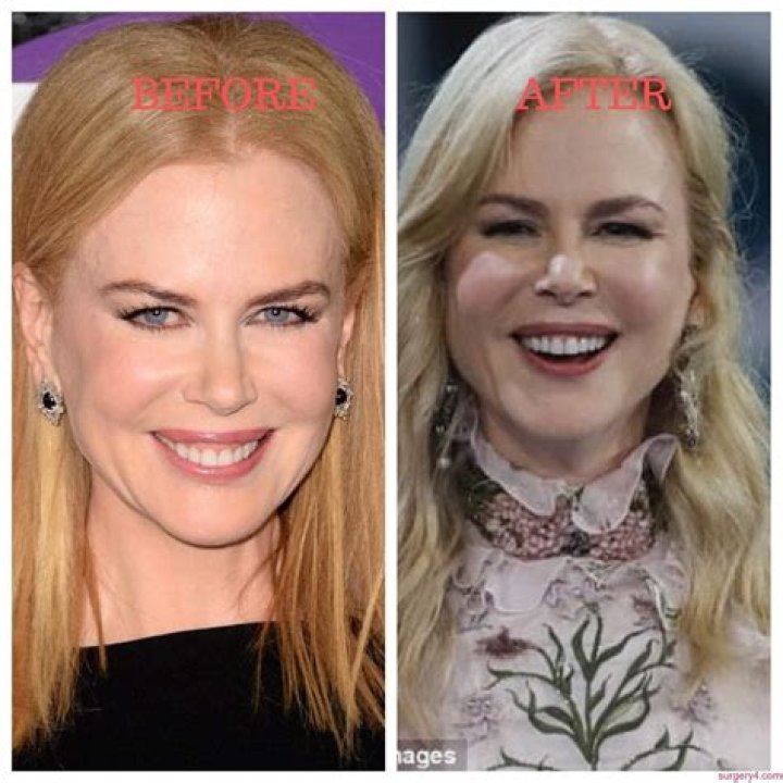 Nicole Kidman Cosmetic Surgery: Exploring the Transformations of a Hollywood Icon