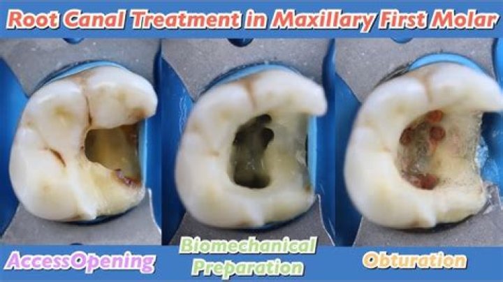 Root Canal Treatment for Top Molar: Everything You Need to Know