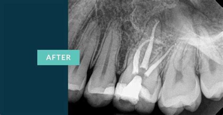 Comprehensive Guide to Upper Molar Root Canal: Everything You Need to Know